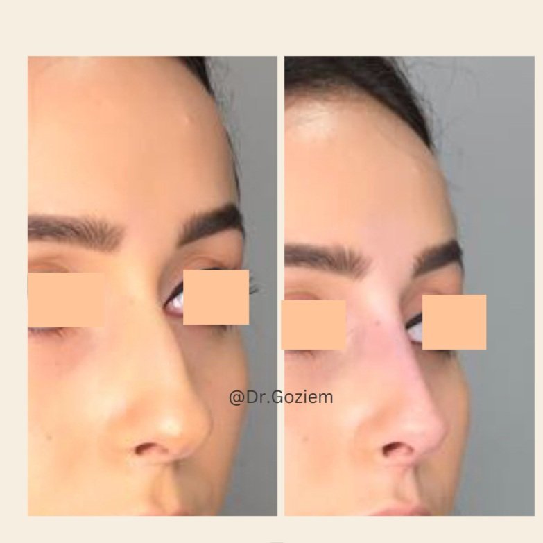 non-surgical nose treatment image