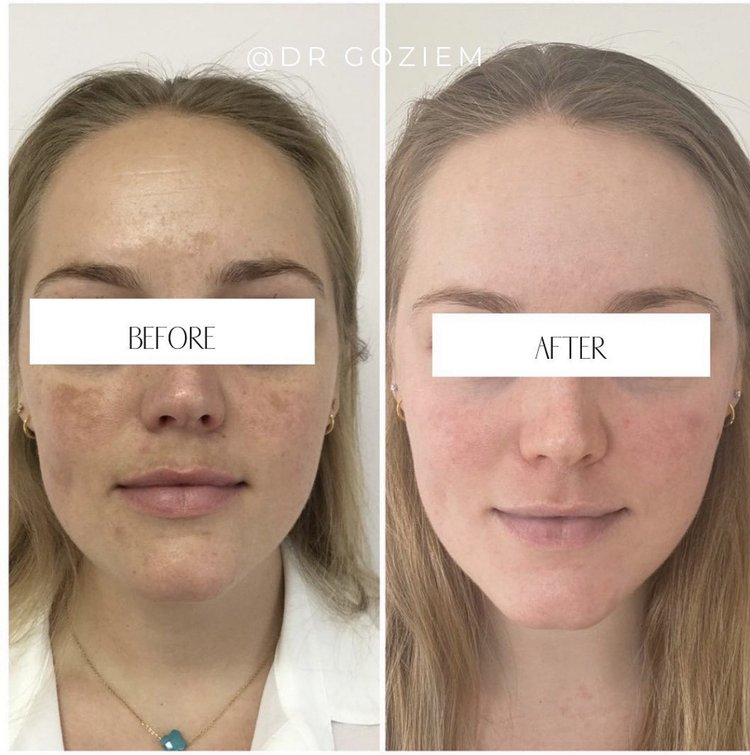 Dr Goziem - before+and+after+pigmentation